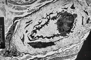 M, 48y. | multiplication of dermal perivascular basement membranes (unclassified myopathy)